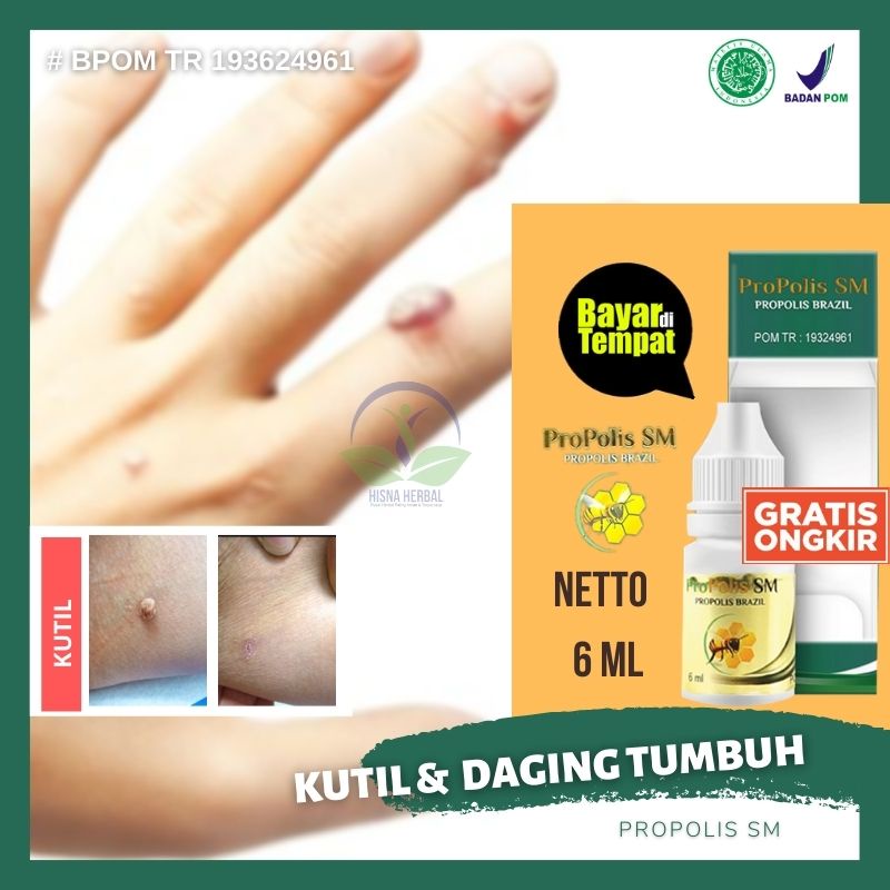 Obat Tetes Untuk Menghilangkan Kutil Virus Kutil Di Tangan, Leher, Wajah, Kaki, Kepala, Gusi, Jari, 