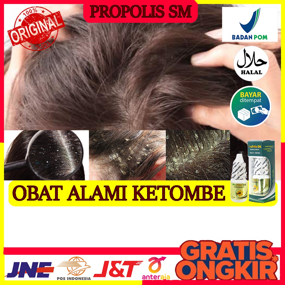 Obat Herbal Ketombe Basah&Kering, Gatal Kulit Kepala, Infeksi Kulit Kepala - Propolis SM - Bisa COD