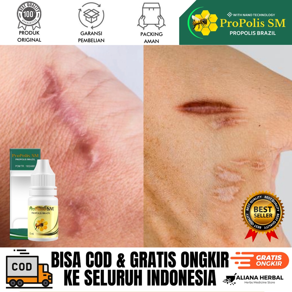 Obat Keloid Homecare24