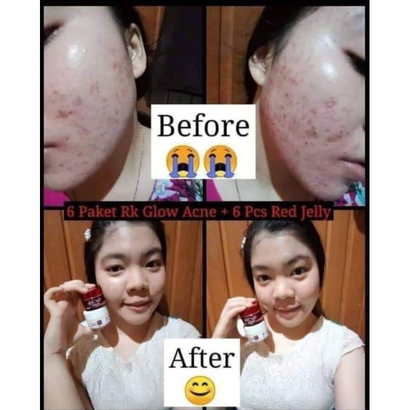 RK GLOW SERIES/RK GLOW ACNE/RK GLOW PREMIUM
