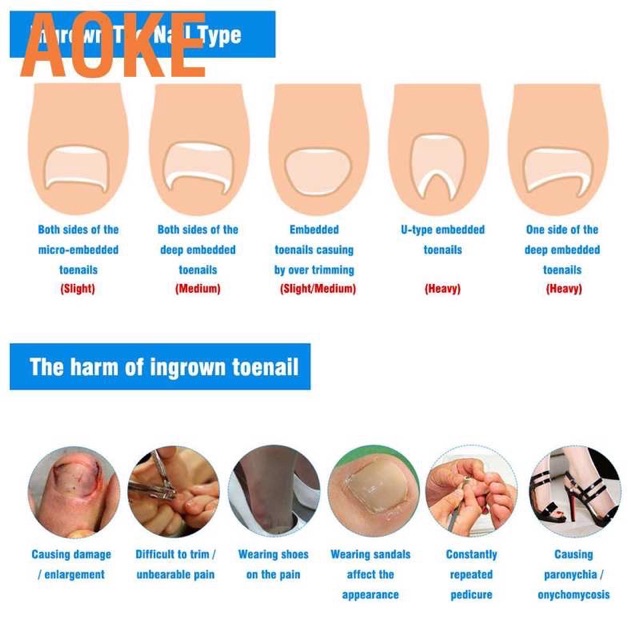 Alat Korektor kuku kaki cantengan / toe nail ingrown pedicure