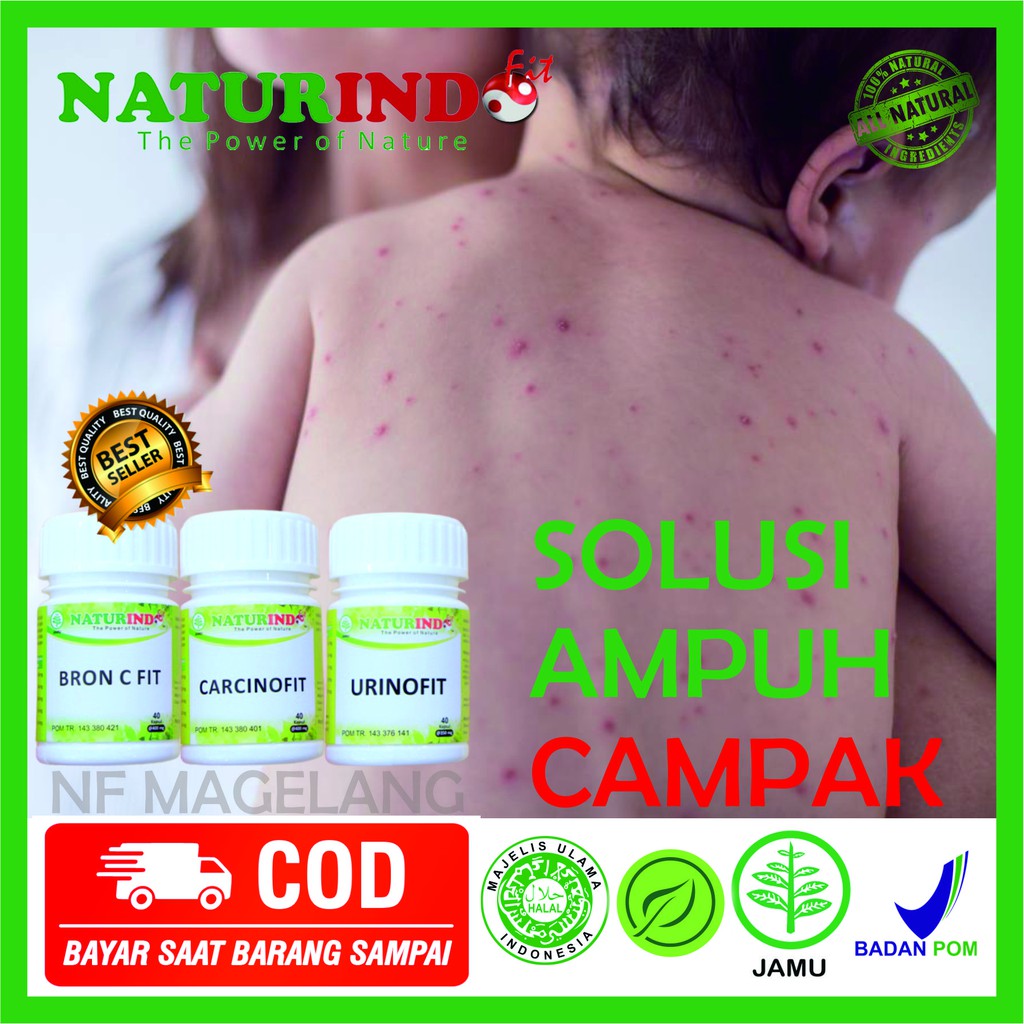 OBAT ruam popok tampek bintik merah pada kulit disertai gatal bintik merah gatal menyebar campak