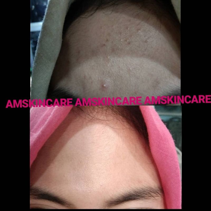 PAKET ACNE  BY AMSKINCARE | AMPUH USIR JERAWAT BANDEL