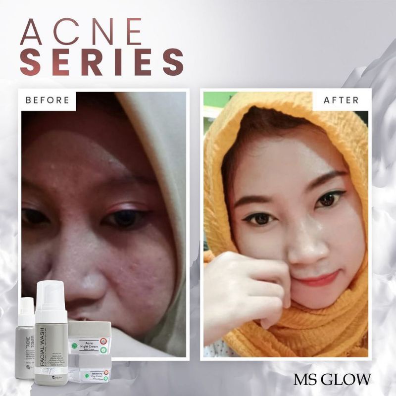 Paket Acne + Red Jelly Lactobacillus || MS GLOW