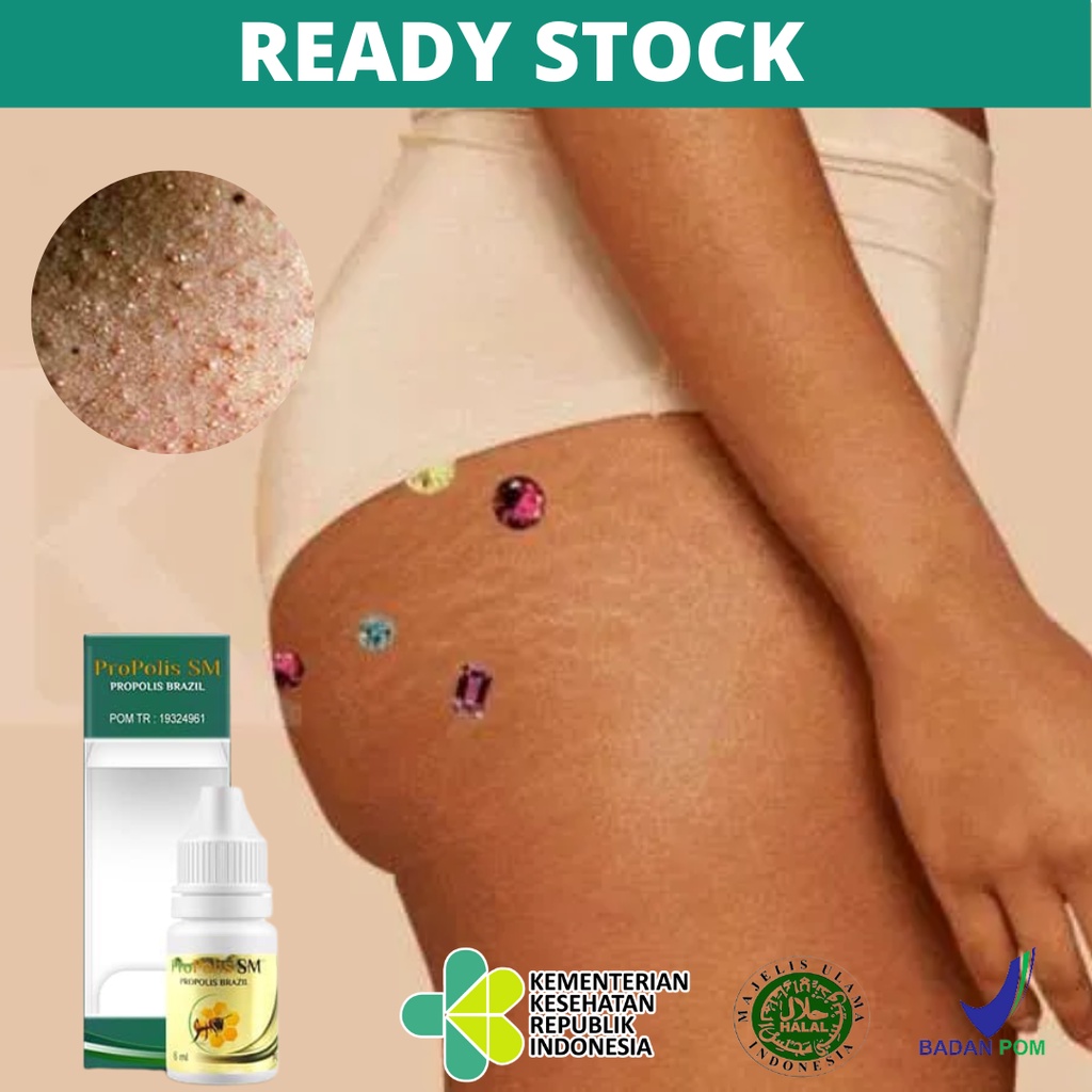 Obat Gatal Bruntusan di Pantat, Obat Pantat Gatal Parah, Korengan di Pantat, Obat Pantat Berkerak, O