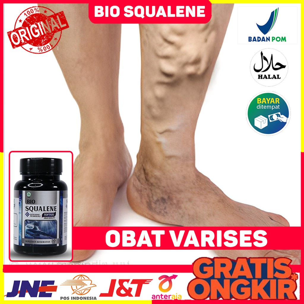 Obat Varises - Obat Varises di Kaki - Obat Varises di Betis - Obat Varises Bengkak - Obat Pereda Var