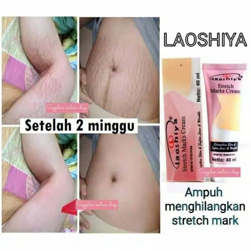 penghilang strechmark salep penghilang bekas luka penghang keloid penghilang selulit ampuh losiya