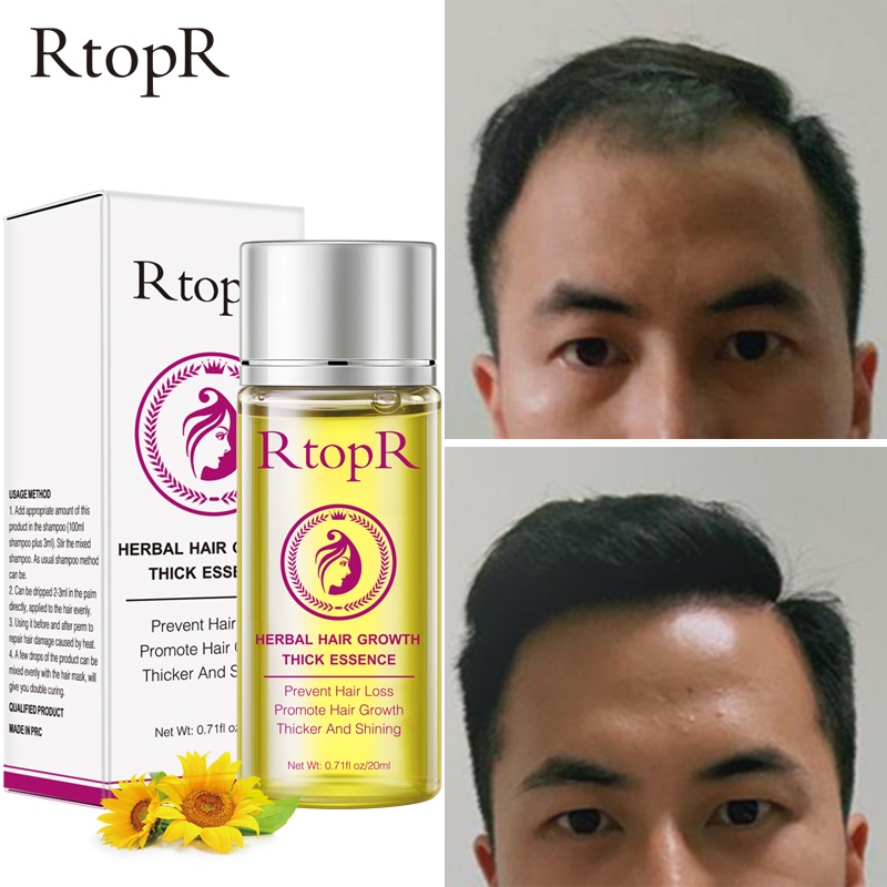 [100% Asli + Ampuh] RtopR Minyak Rambut Anti Rontok Botak Perawatan Pertumbuhan Rambut Cepat Tebal 20ml