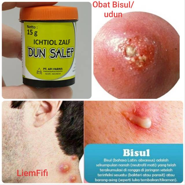 Salep Bisul Udun Salep Ichtiol Ichtyol Ictiol Ictyol Hitam Item Dun 15 Gr Shopee Indonesia