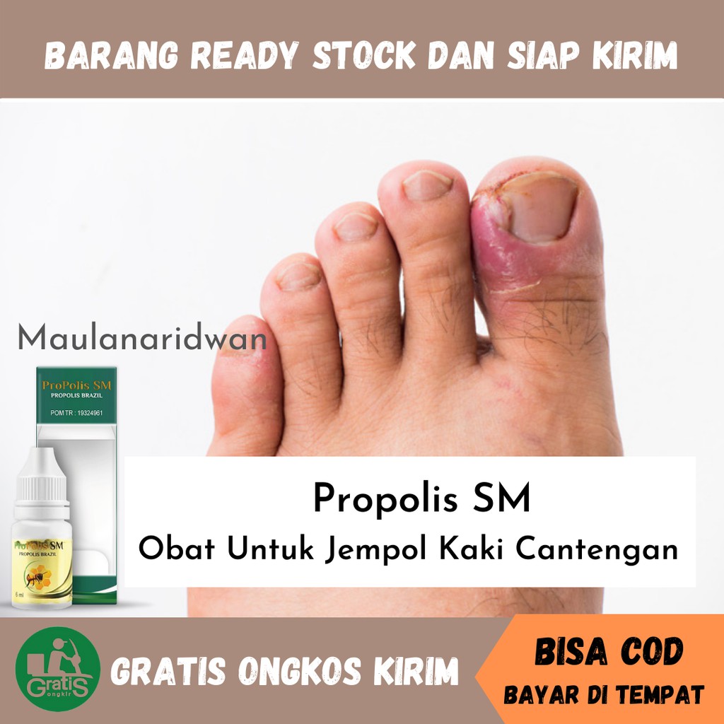 Obat Jempol Kaki Cantengan, Bernanah, Cantengan Parah & Bengkak, Obat Kuku Cantengan - Propolis SM