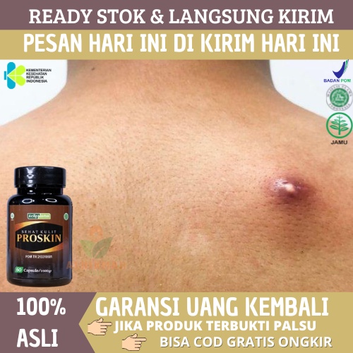 Obat Bisul, Obat Bisulan, Obat Bisul Bernanah, Obat Bisul di Pantat, Obat Bisul Di Paha, Obat Bisul 