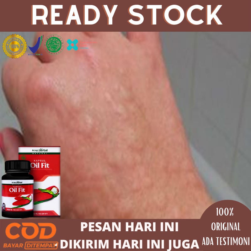 Obat Biduran Menahun, Alergi Makanan, Gatal Gatal Bentol Di Tubuh Herbal Alami, obat alergi gatal ku