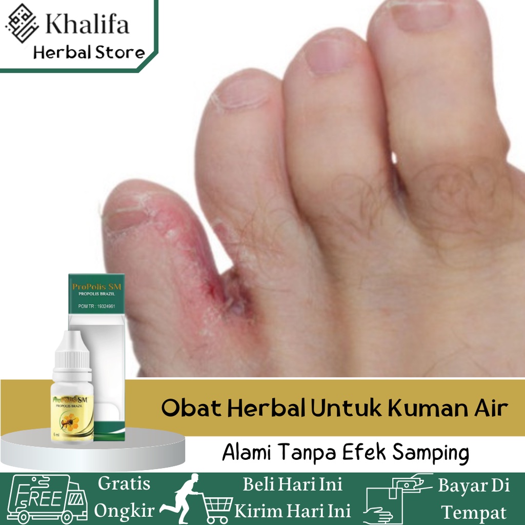 Obat Kutu Air, Obat Kutu Air Di Sela Jari, Obat Kutu Air Di Kaki, Obat Kuman Air, Obat Sela Jari Per