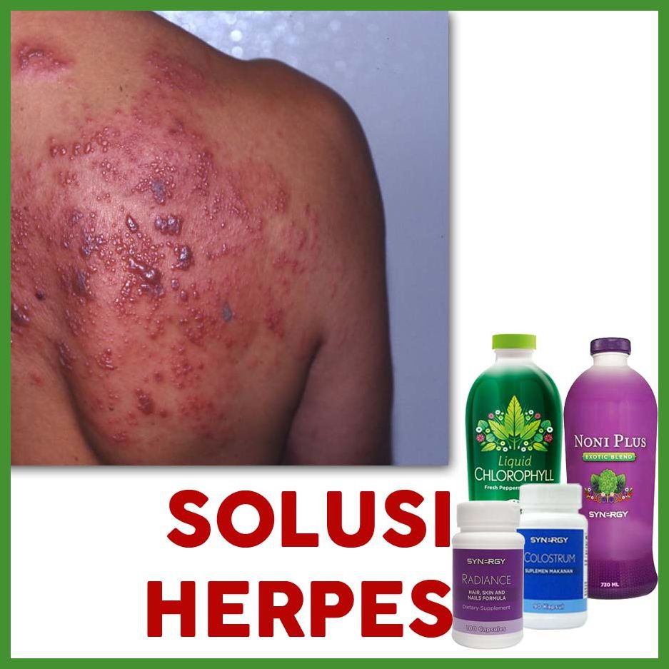 Obat Mengatasi Cacar Api / Cacar Ular / Herpes Paling Dicari