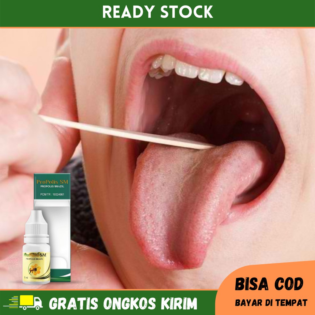 Obat Radang Lidah, Lidah Bengkak, Lidah Putih, Sariawan Di Lidah, Obat Bercak Putih Di Lidah