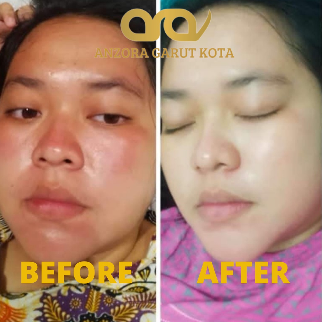 ANZORA ANZORA SKINCARE ANZORA SKINCARE GLOWING ANZORA ACNE ANZORA ACNE DARK SPORT ANZORA SKINCARE ORIGINAL SKINCARE ACNE SKINCARE KECANTIKAN PERAWATAN WAJAH PERAWATAN WAJAH ANZORA BODY LOTION SKINCARE GLOWING SKINCARE WAJAH BERJERAWAT  ANZORA GARUT KOTA-5