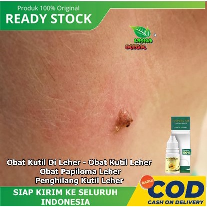 Obat Kutil Di Leher - Obat Kutil Leher - Obat Papiloma Leher - Penghilang Kutil Leher - Propolis SM 