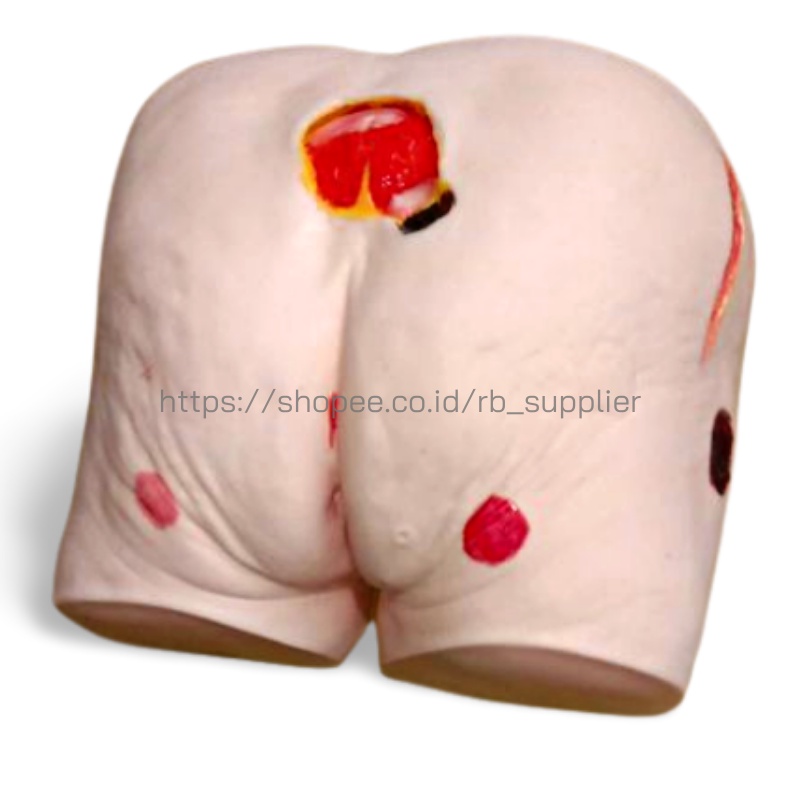 Ulkus Dekubitus | Bokong/Pantat Decubitus Simulator | Luka Baring (Bedsores)