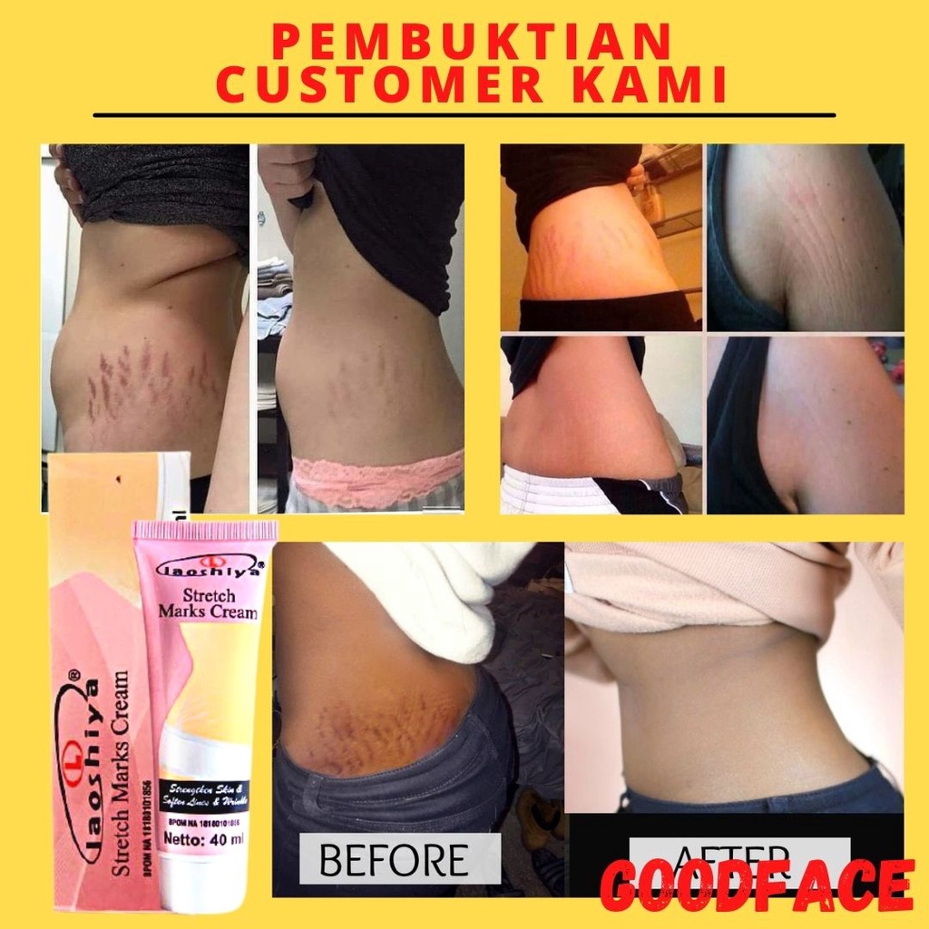 LAOSHIYA STRETCH MARKS CREAM ORIGINAL BPOM STRETCH MARKS LAOSHIYA PENGHILANG STRECT MARK