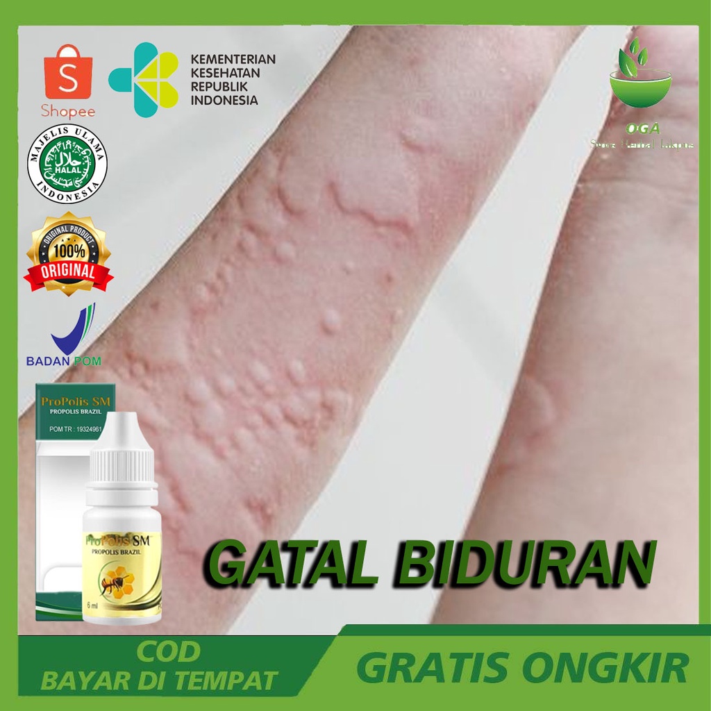 Obat Biduran - Biduran Alergi - Biduran Gatal - Biduran Menahun - Biduran Anak - Biduran Alergi 100%