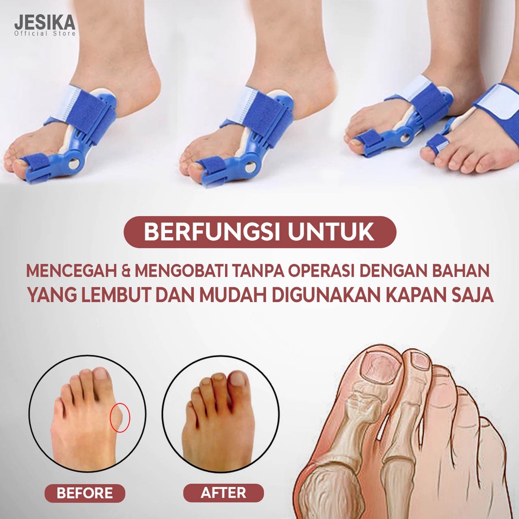 korektor jempol kaki thumb bunion hallux terapi jempol kaki bengkok