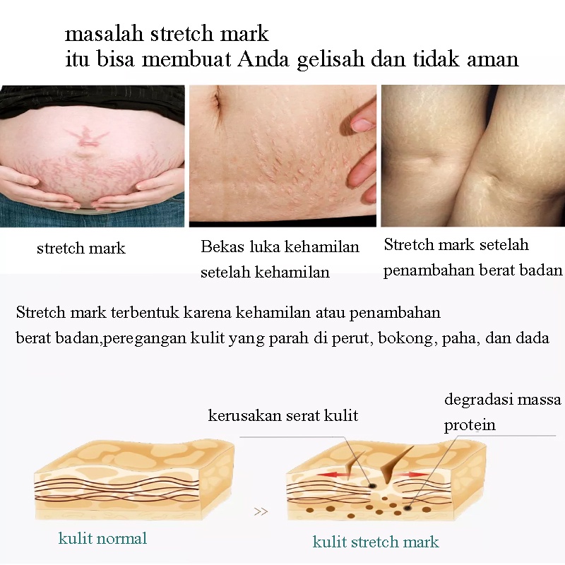 Krim Kehamilan StretchMark 30ml Cream krim bekas luka Pengencang Kulit Solusi Perut Gatal dan Anti Stretchmark Ibu Hamil StretchMark Krim Penghilang Stretch Mark mama choice stretch mark