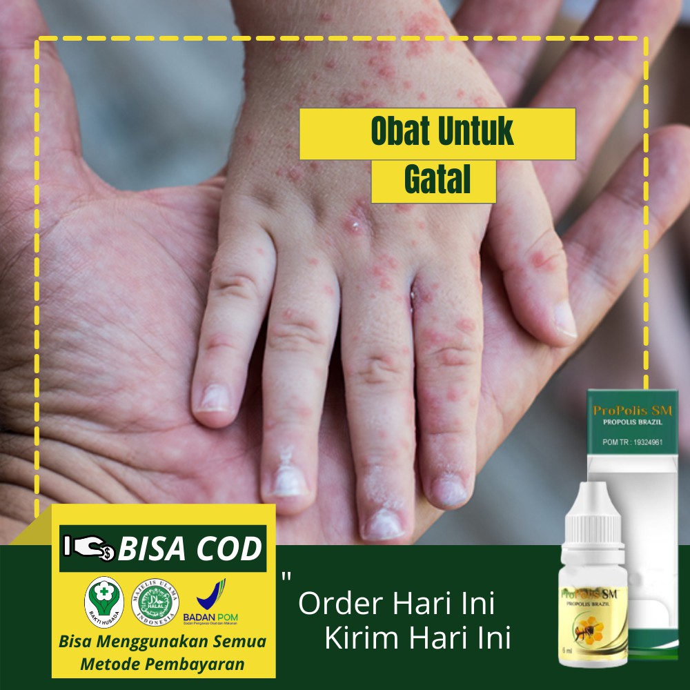 Obat Gatal Alergi Bintik-bintik, Herbal Gatal Alergi Bentol Kulit, Kulit Merah Dengan Propolis SM