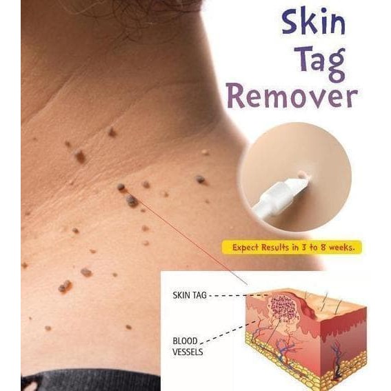 Obat Penghilang Kutil Tahi Lalat Ampuh  / Skin Tag Remover Original Recomendid