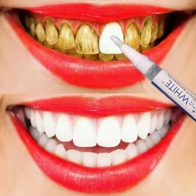 pen gel dazzling white