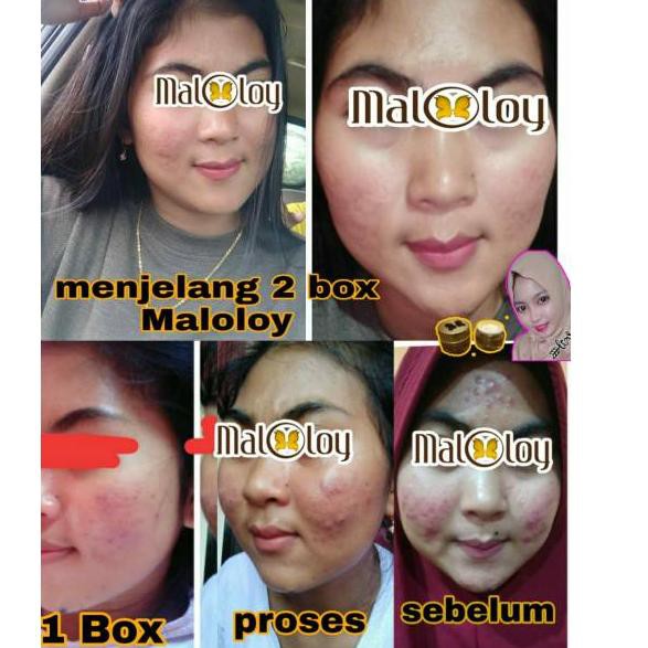 [VIP] Cream maloloy sepaket cream bisa di pake siang dan malam CDD2