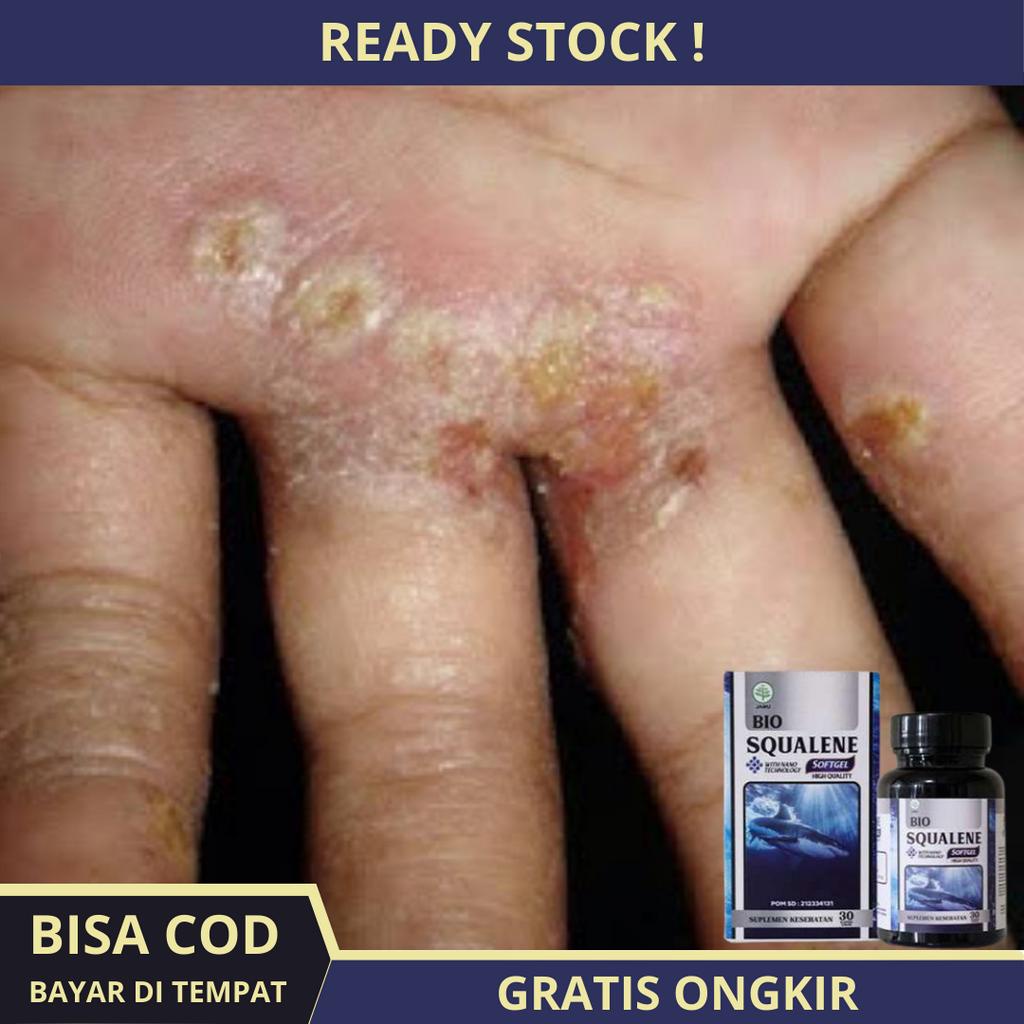 Obat Scabies Manusia, Pembasmi Kutu Sekabies, Kudis, Gudik, Budug, Budug Di Kaki, Budug Bernanah, Bu