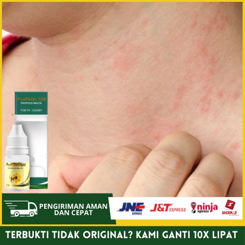 Obat Gatal Di Leher, Mengatasi Kulit Leher Gatal Dan Panas Dengan Propolis SM