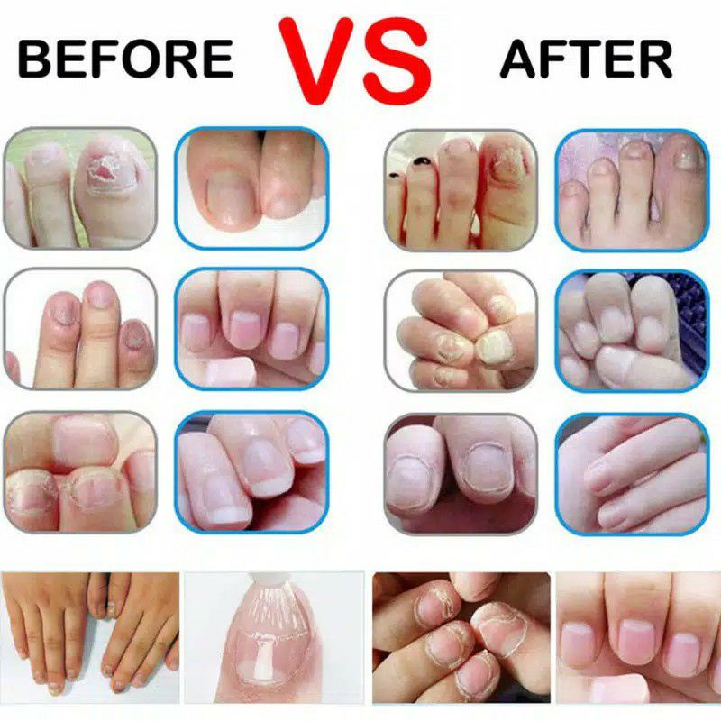 Cairan Obat Infeksi Anti Jamur Untuk Perawatan Kuku Nail Care Solution