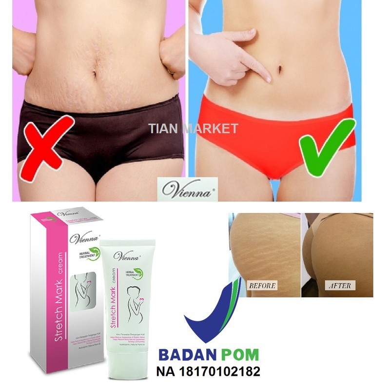 VIENNA STRETCHMARK CREAM CICA+ SOLUTION ORIGINAL - PENGHILANG STRETCH MARK PERUT PAHA