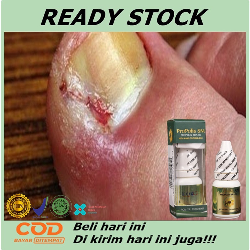 obat kuku cantengan, obat tetes kuku centengan, obat cantengan tangan, kaki, obat cantengan herbal o