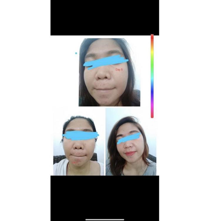 Facial Wash FW ACNE Scrub Cleansing Acne Clear Jerawat Sabun Wajah ori bpom krim farma dokter korea