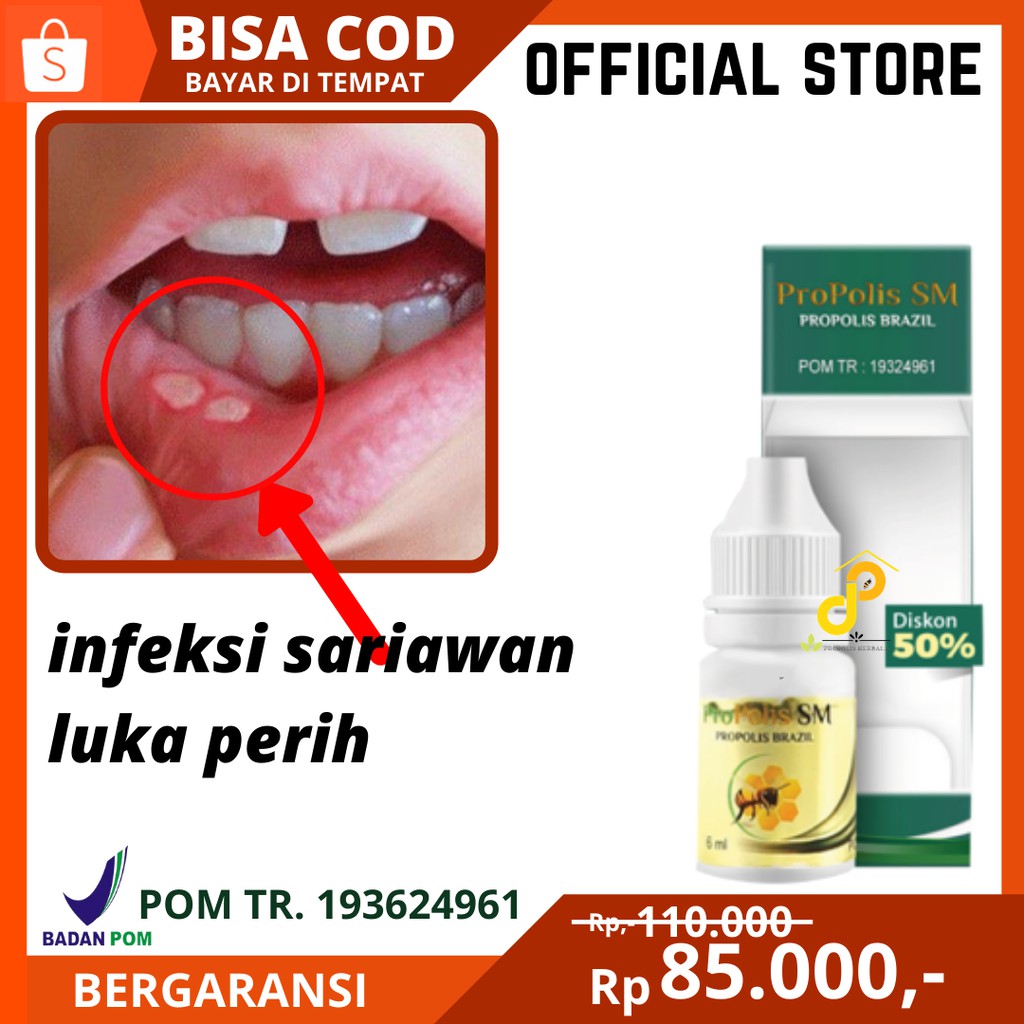 Propolis SM Obat Sariawan untuk anak dan Dewasa, Infeksi Sariawan, obat Barusuh, Penghilang sariawan
