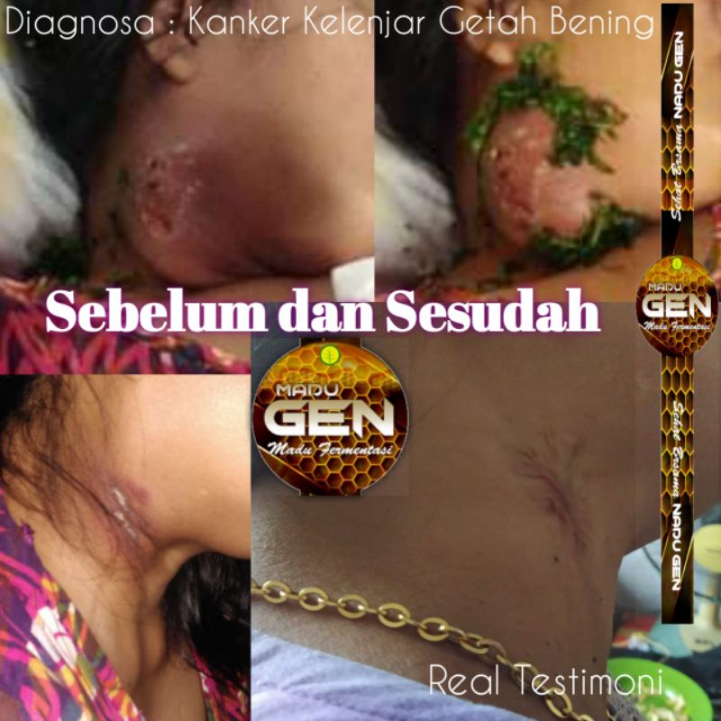 MADU ANTI VIRUS ANTI KANKER | MADU FERMENTASI | Madu Hutan Banyuwangi