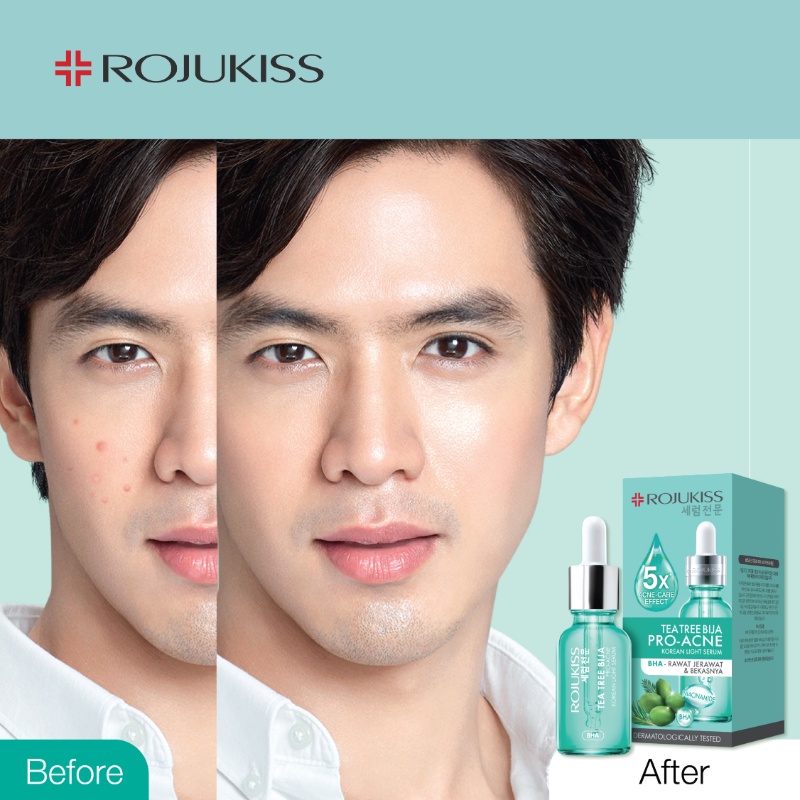 Rojukiss Tea Tree Bija Pro-Acne Korean Light Serum