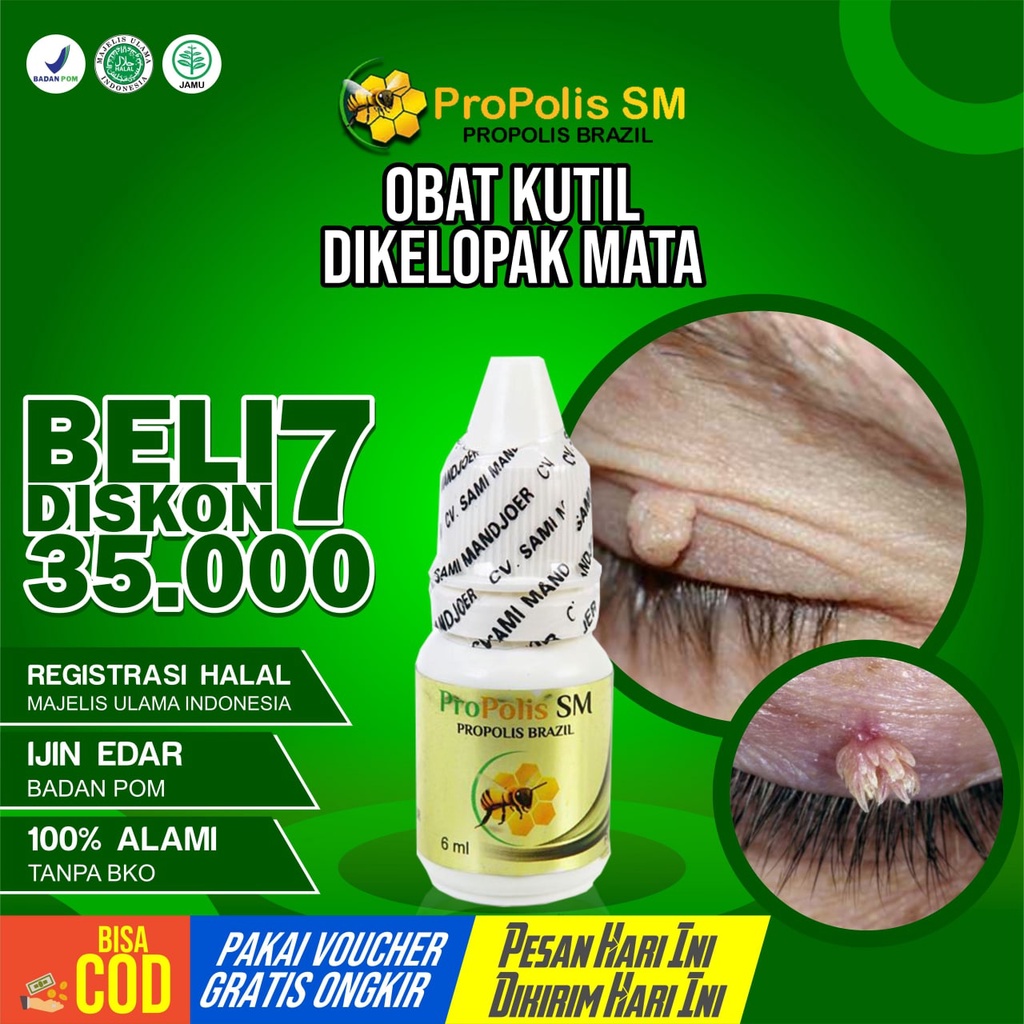 Penghilang Kutil Di Kelopak Mata Dibawah Kelopak Mata  Milia Tahi Lalat Papiloma Benjolan Sariawan P