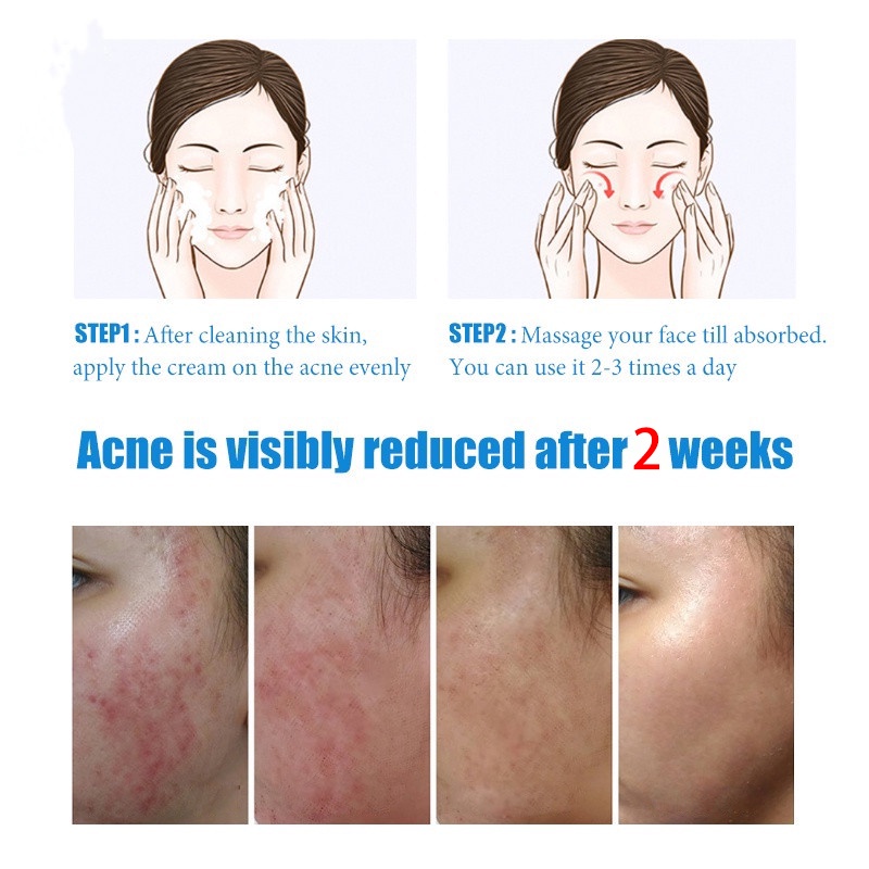 cream jerawat obat totol jerawat krim jerawat obat jerawat dan bekas jerawat Jerawat Removal of Acne Cream Untuk Pria dan Wanita Menghilangkan jerawat dengan cepat