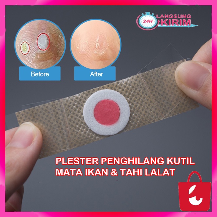 [100% Ampuh] Plester Kutil Mata Ikan Obat Kutil Mata Ikan Tahi Lalat Plester Kutil Penghilang Pencabut Kaki Leher Wajah Foot Corn Removal Plaster