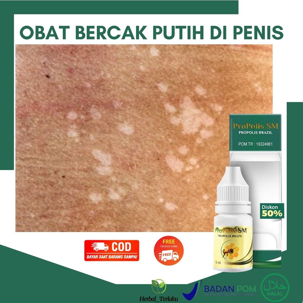 Jual Obat Bercak Putih Di Penis Infeksi Jamur Ruam Putih Di Batang Penis Gatal Daki