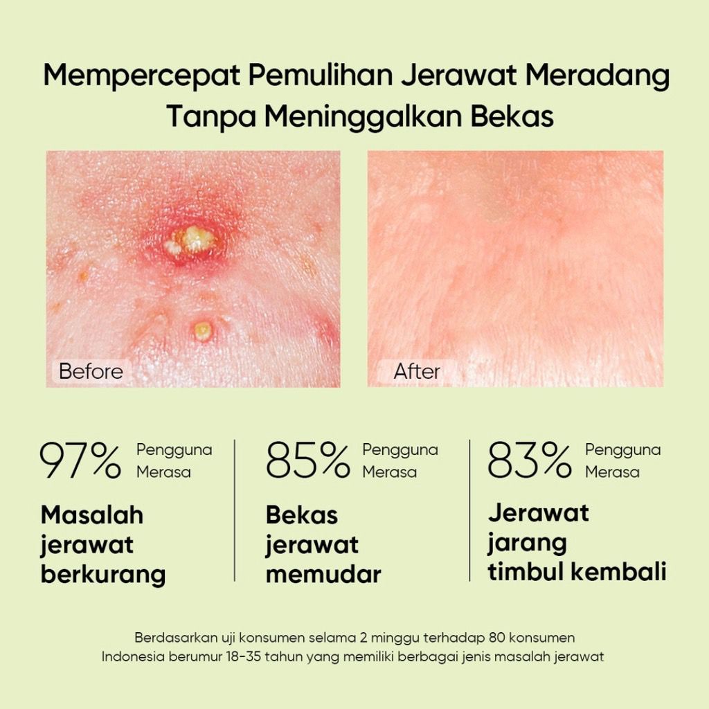 RCS ✅ NEW ~ SKINTIFIC - Salicylic acid acne spot treatment 10g obat jerawat