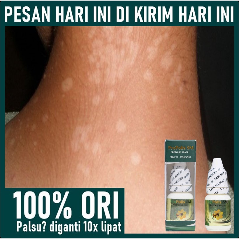 Obat Oles Panu - Obat Panu Cair - Obat Jamur Panu - Obat Panu Anak - Obat Panu Kadas Kudis Kurap