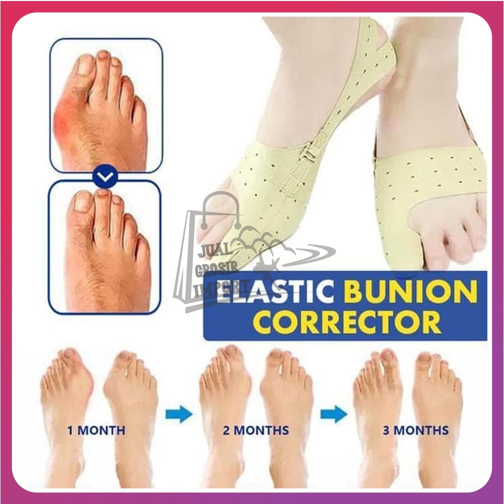 Alat Terapi Jempol Kaki Korektor Tulang Jempol Bunion Corrector Elastic