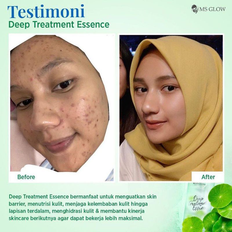 MS Glow Deep Treatment ESSENCE/ MS Glow Deep ESSENCE Treatment Original Penghilang Jerawat Permanen