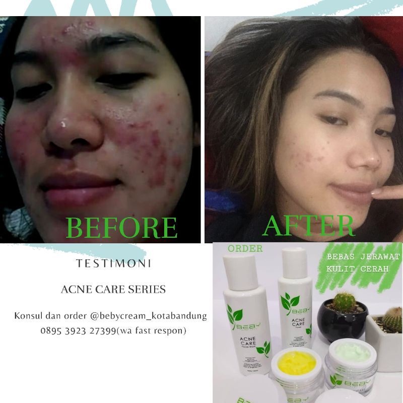 ANTI ACNE GEL SPOT BEBY (TOTOL JERAWAT)