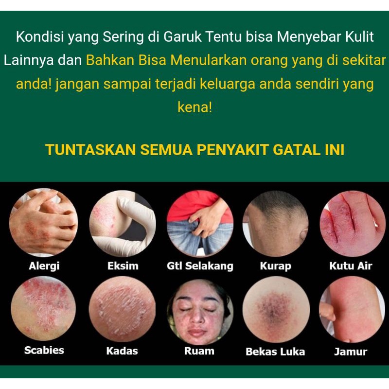 Salep ZUDAIFU salep kulit | Obat gatal Paling Ampuh Atasi jamur kurap Kudis 100% Original