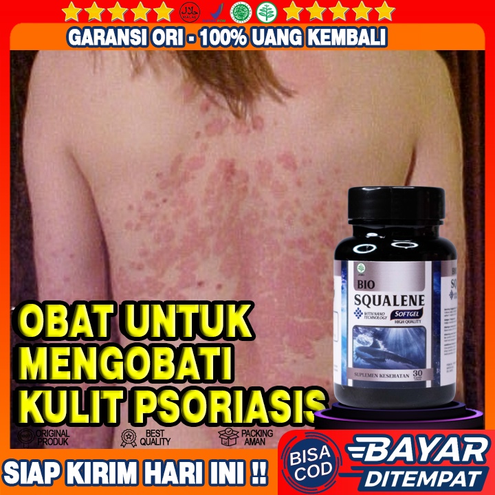 Obat Psoriasis - Obat Penghilang Gatal Di Kulit Kepala Akibat Infeksi Jamur - Obat Gatal Jamur - Oba